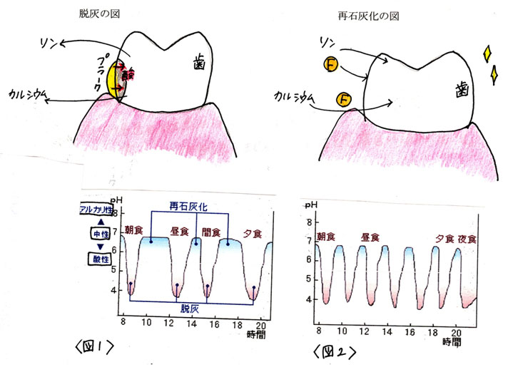 フッ素の虫歯予防効果